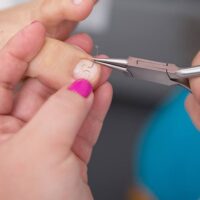 Batık Tırnak Onarımı